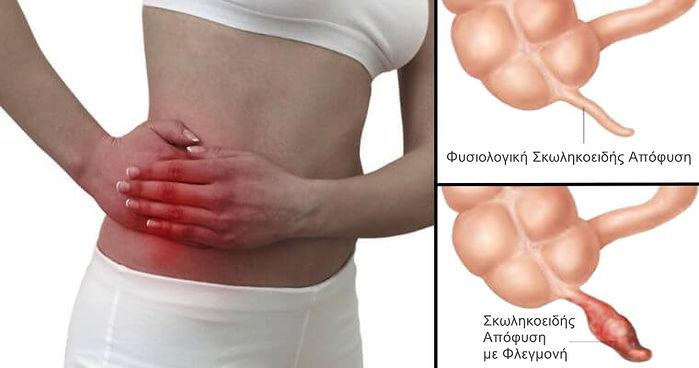 Λαπαροσκοπική Σκωληκοειδεκτομή (2).jpg