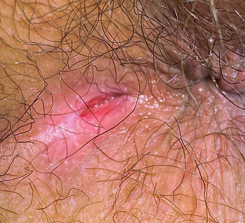 περιεδρικο συριγγιο, περιεδρικό συρίγγιο Laser, Περιεδρικό Συρίγγιο, Απόστημα Πρωκτού, περιεδρικο συριγγιο κοστος, Περιεδρικο συριγγιο laser τιμη, συριγγιο πρωκτου, περιεδρικο συριγγιο εικονες