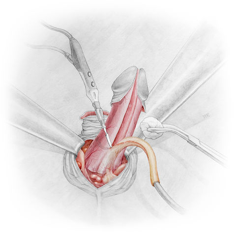 Manuel Ruoss wissenschaftliche scientific medical medizinische Illustration Anatomie Chirurgie Gender Dysphoria Geschlechtsangleichende Operation Trans