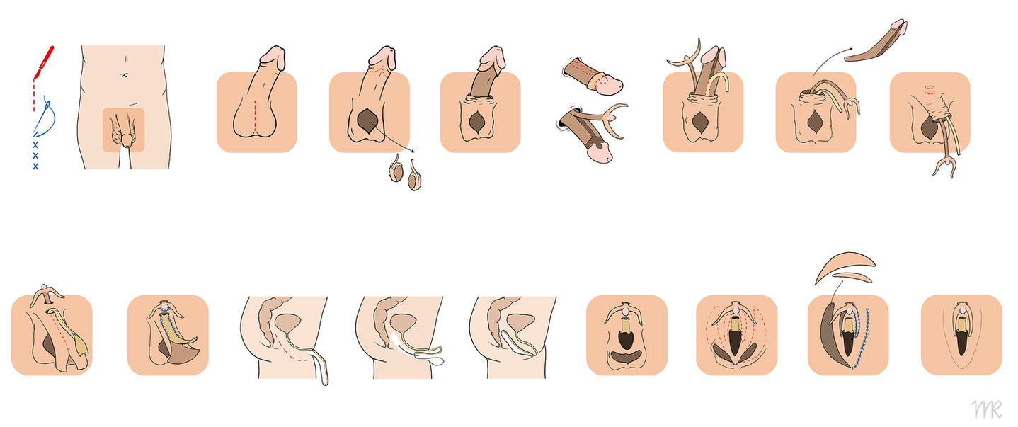 Manuel Ruoss wissenschaftliche scientific medical medizinische Illustration Anatomie Chirurgie Gender Dysphoria Geschlechtsangleichende Operation Trans
