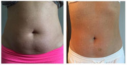 Tummy Before & After 4 Treatments