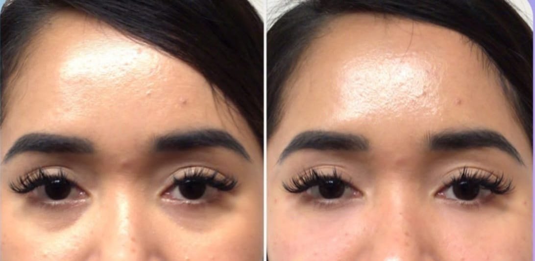 Eye Vitalita (Under Eye Filler)