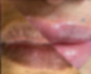 lip neutralization.jpg