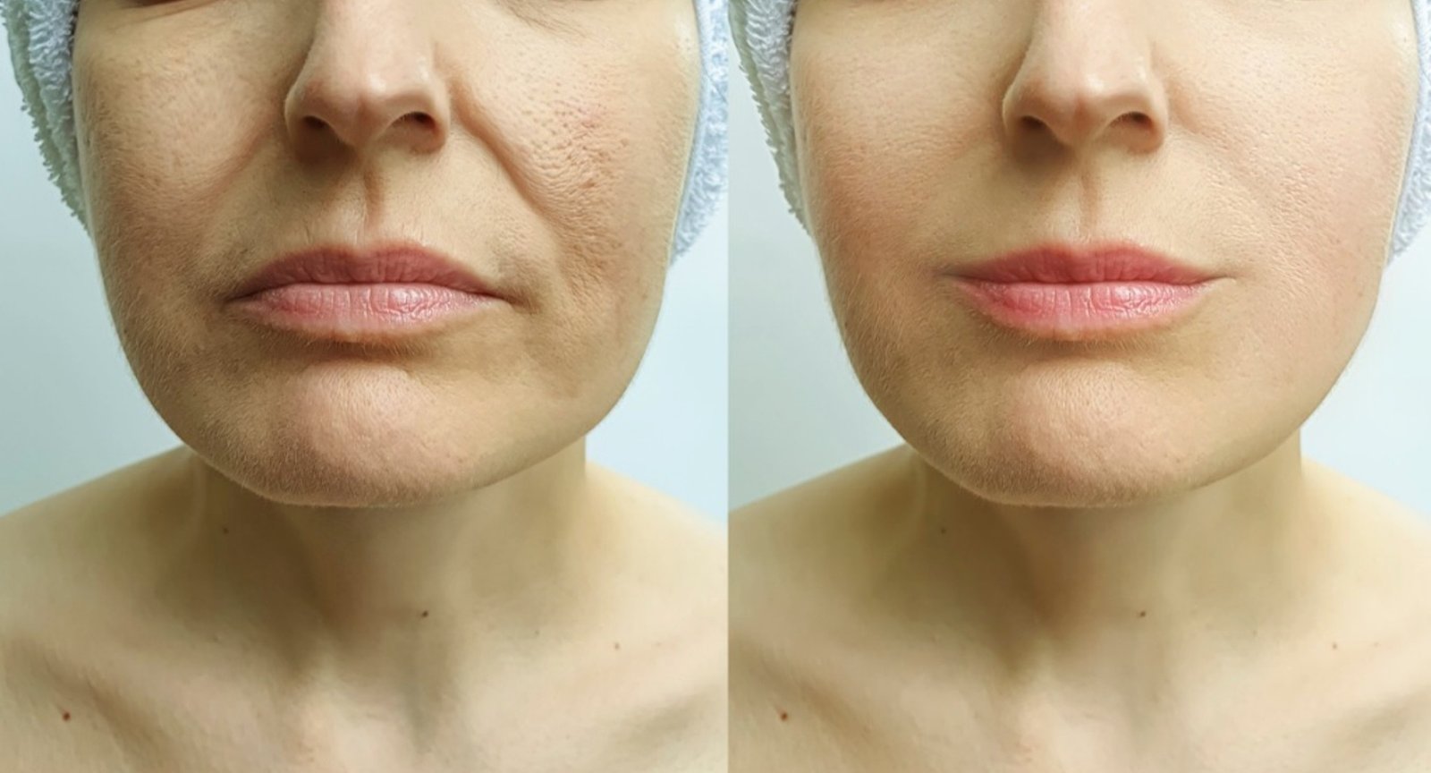 Nasolabial Fold Filler