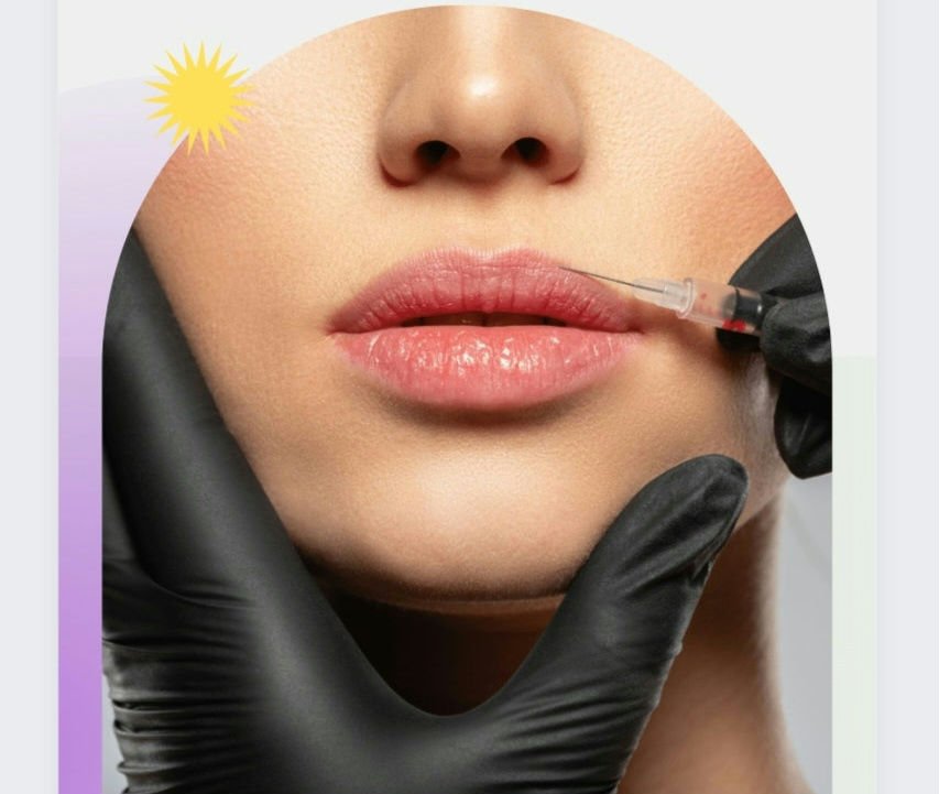 Lip Filler