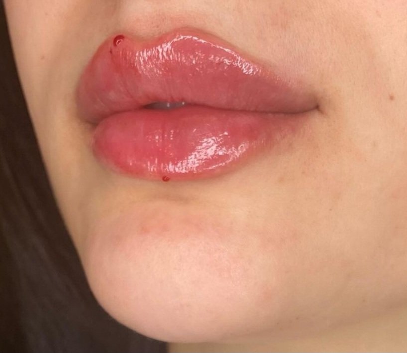Botox and Filler Training