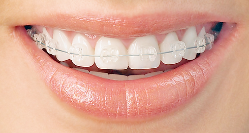 braket ceramiques 2.png