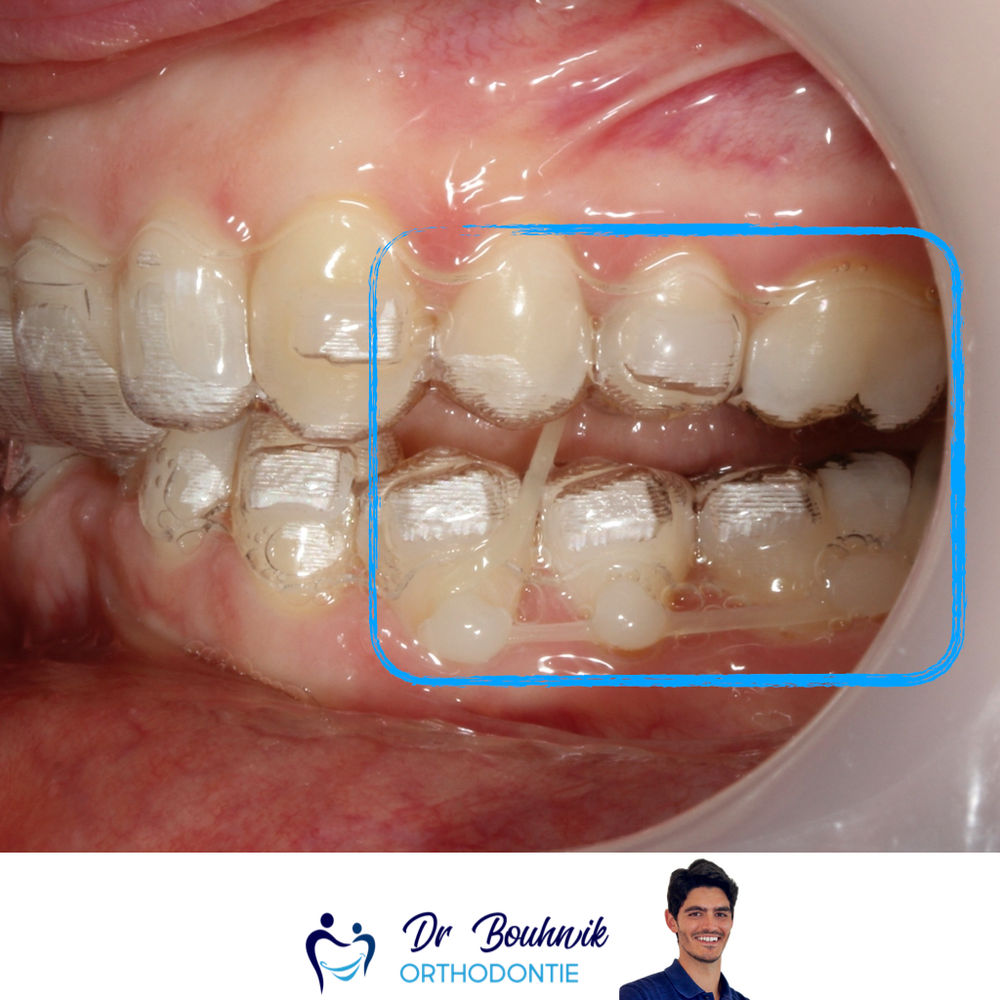 A quoi servent les élastiques dans un traitement d’orthodontie?