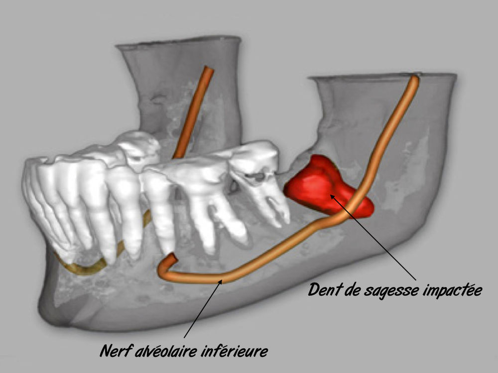 Dents de sagesse et Orthodontie