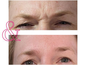 A Quick Guide to Neurotoxin Injections (a.k.a. Botox)