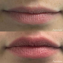 Lip Rejuvenation - 1 Treatment - Aerolase.jpg