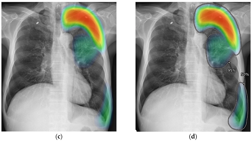 An example of the heat map explainability method used when detecting clinically significant abnormalities within chest radiographs, where colour represents the AI’s confidence (Hong et al., 2023).