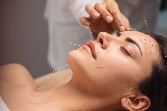 Acupuncture et ventouses chinoises
