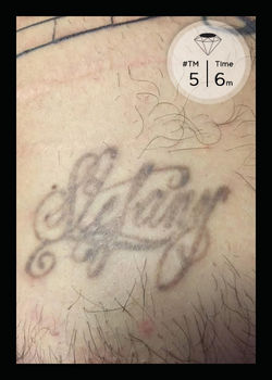 Chroma Collective Laser Removal