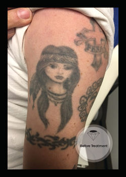 Chroma Collective Laser Removal