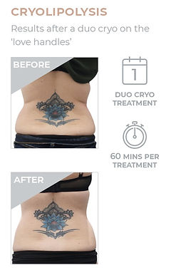 cryo before & after.jpg