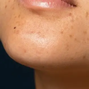 Lekelerinizin Türü Ne? Güneş Lekesi mi, Melazma mı?