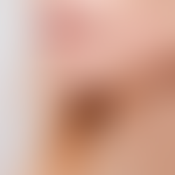 Yetişkin Aknesi Nedir?