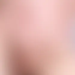 Akne Neden Geçmez? Geçmeyen Sivilcelerin Arkasındaki Tıbbi Gerçekler