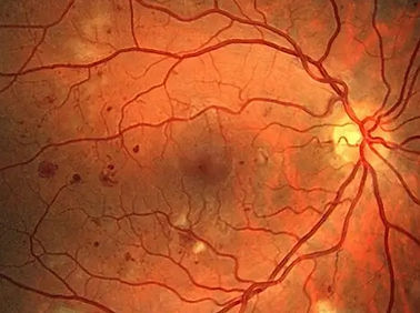 Retina-Diabetes-NPDR_edited.jpg