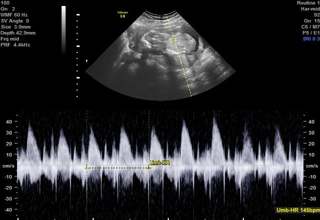 Understanding the Key Differences Between Pelvic Transabdominal and Transvaginal Ultrasounds