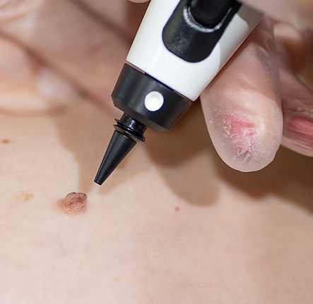 white tip and skin tag.jpg