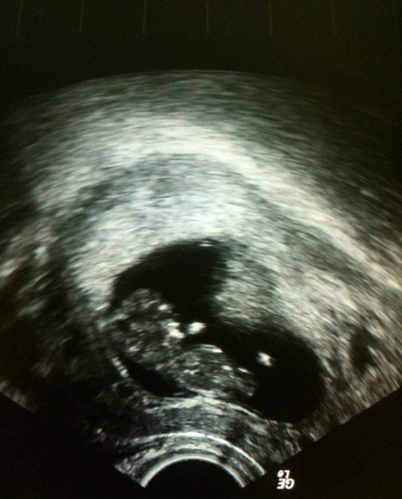 After Three Miscarriages, I Finally Got An Answer Still Loved