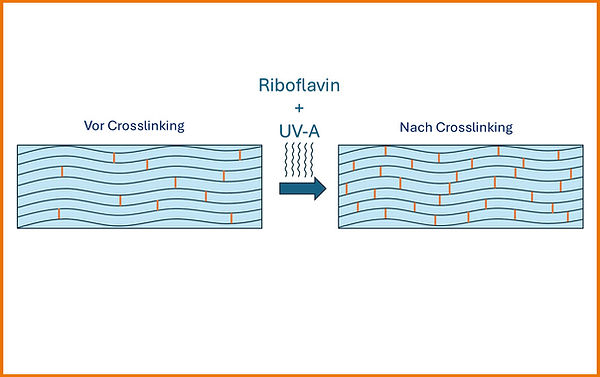 Crosslinking Hornhaut, Vista Alpina Augenklinik, Sitten, Siders, Visp, Brig, Behandlung, Therapie, Keratokonus