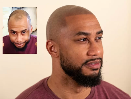 Scalp Pigmentation: Creating a Natural Hair Density Effect, Covering Sparse Scalp Areas