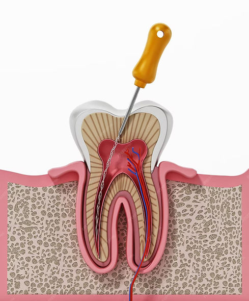 3d-illustration-root-canal-treatment-process_613961-299.jpg