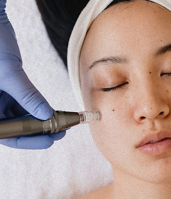Nano + Micro-needling Tips _ Kin Aesthetics – by Kin Aesthetics_edited.jpg