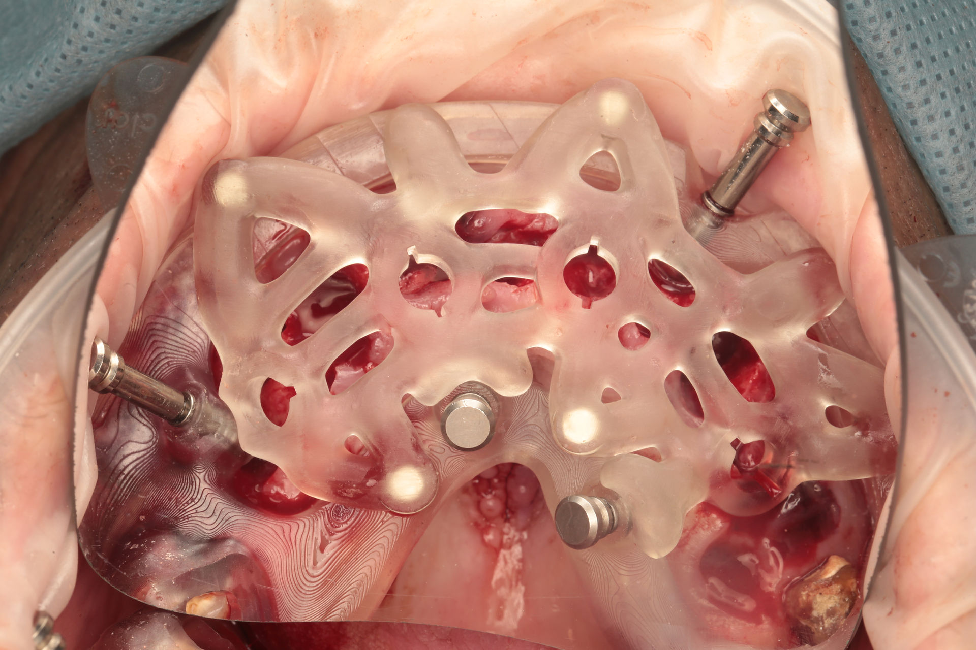 Osteotomy template in place on the edentulous maxilla after the remaining teeth were extracted