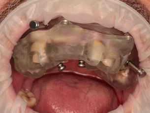 Metal-reinforced base template seated on the maxilla and locked with bone-anchored fixation pins