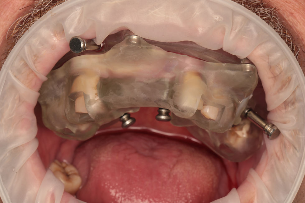 Metal-reinforced base template seated on the maxilla and locked with bone-anchored fixation pins