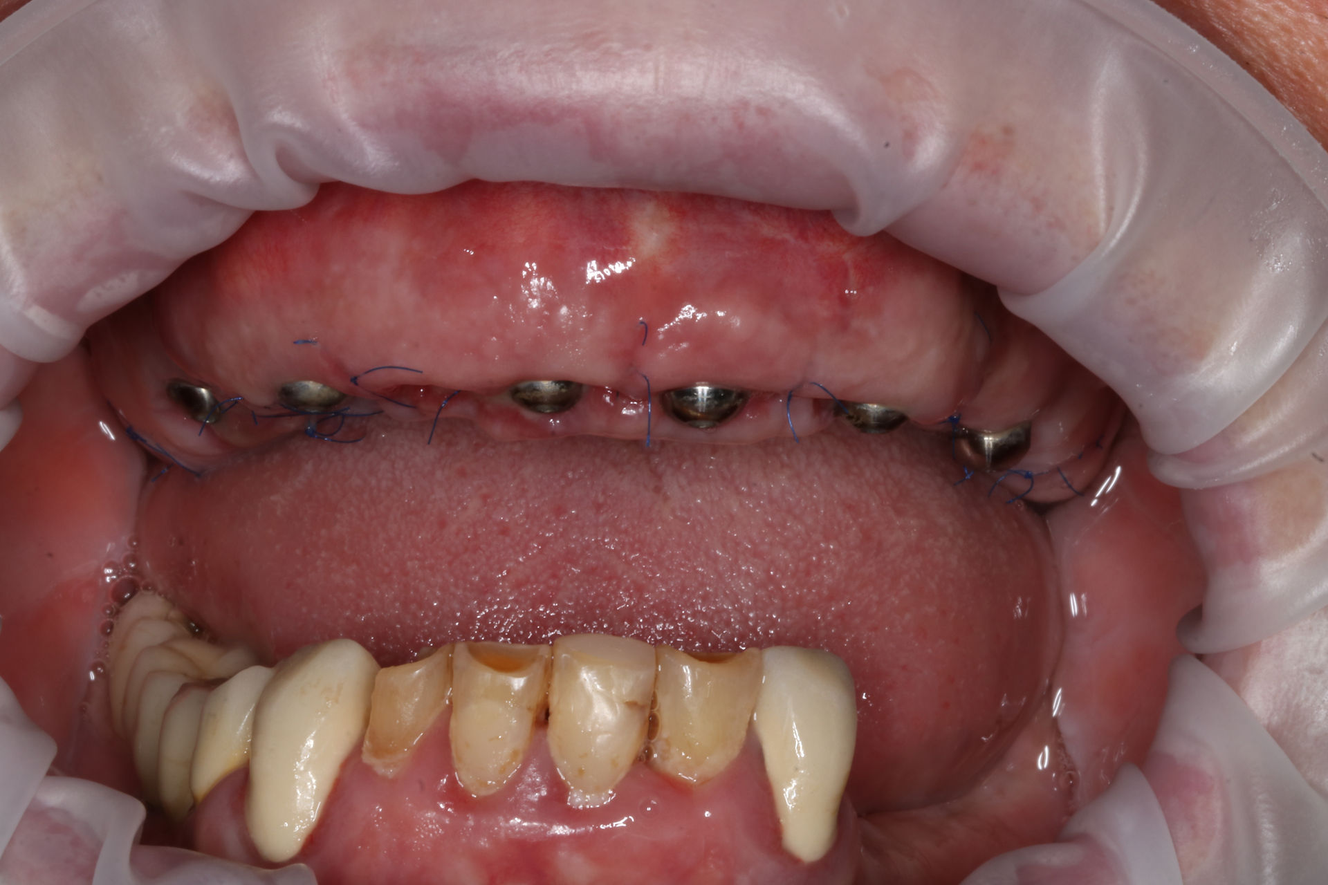 Maxillary multi-unit abutments against the opposing natural dentition