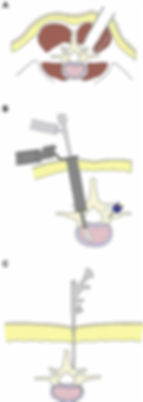 微創脊椎手術方式