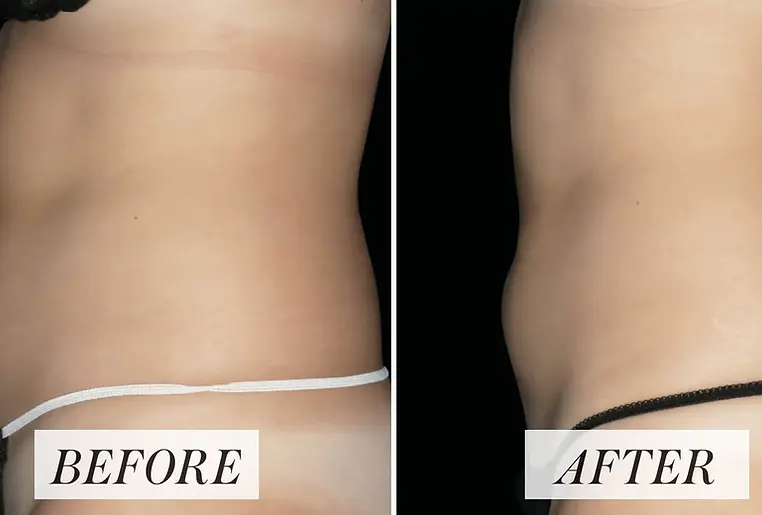 M Sculpt Bdy sculpting before and after