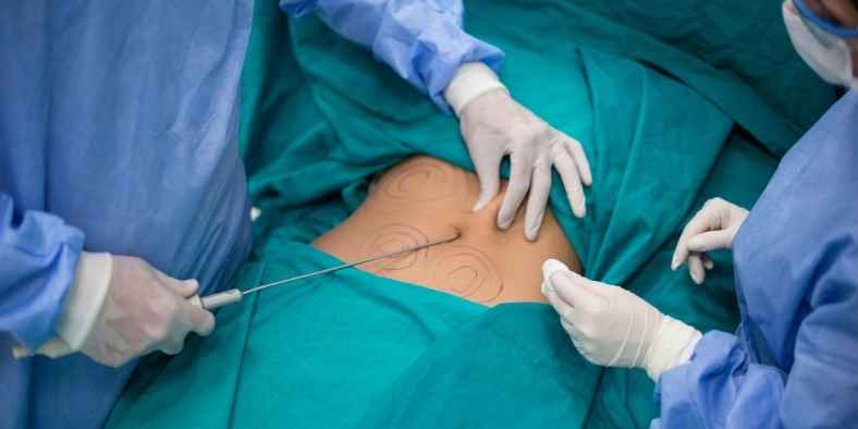 How Much Weight Can You Lose With Liposuction?
