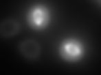 Cancer cells proliferating. The orbes are the outline of the cell and the white strings in the center are spots where the two copies of DNA are being pulled in oposite directions, after which the orbs will split in two producing a new copy.