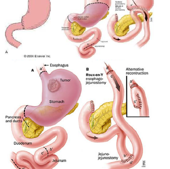 Cirugía Bariátrica metabólica y obesidad/ Secuelas de la Cirugía Gastroduodenal - Dra. Debbie Wong