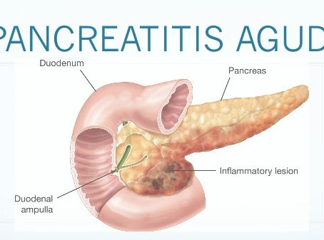 Pancreatitis aguda - Dr. Moisés Cukier