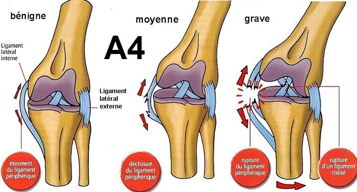 Les stades des entorses du genou / ostéopathie lyon