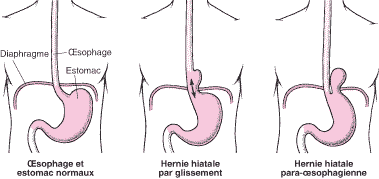 Hernie Hiatale et ostéopathie