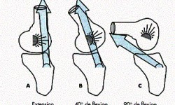 Cause du syndrome de l'essuie glace