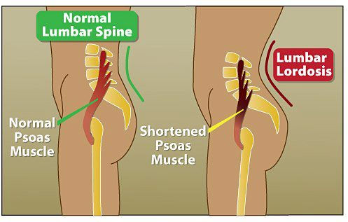 douleur lombaire et psoas