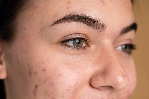 acne.jpg