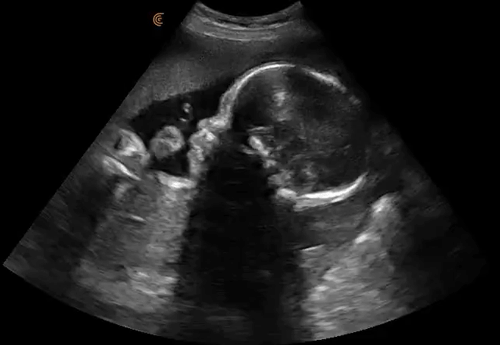 OB-Fetal ultrasouns in Rocky Point Sonora Mexico.gif