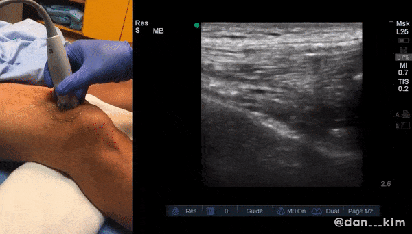 MUSCULOSKELETAL ULTRASOUND IN ROCKY POINT SONORA MEXICO.gif