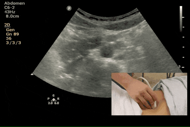 abdominal ultrasound.gif