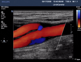 DOPPLER ULTRASOUND IN ROCKY POINT SONORA MEXICO ONCOLOGIC IMAGING.gif